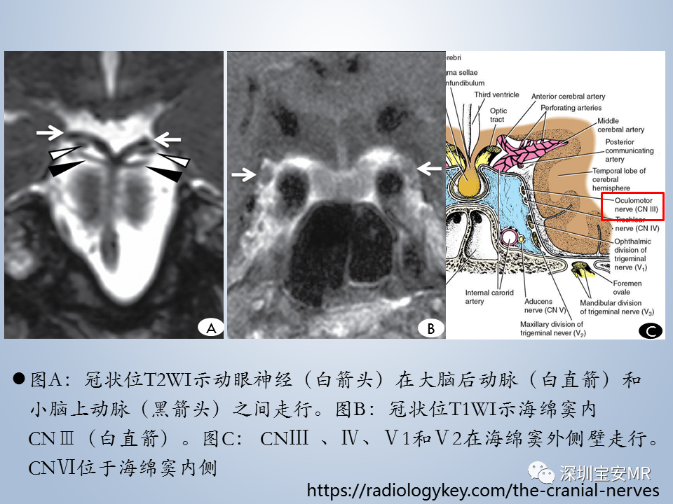 影像PPT - 【PPT】眼球运动障碍影像诊断-10