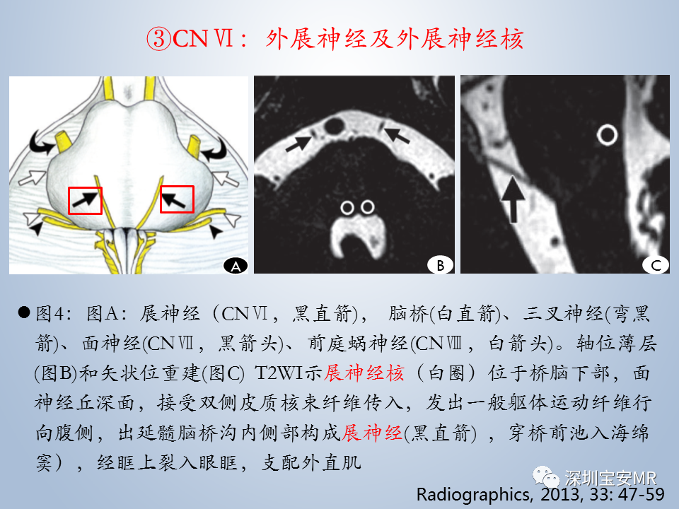 影像PPT - 【PPT】眼球运动障碍影像诊断-15