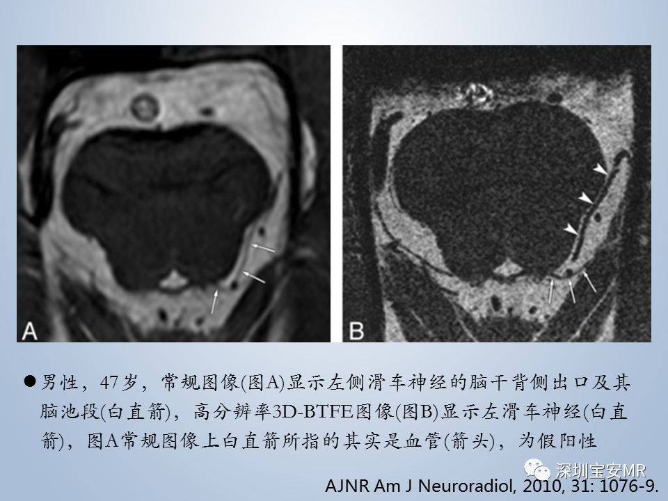 影像PPT - 【PPT】眼球运动障碍影像诊断-14