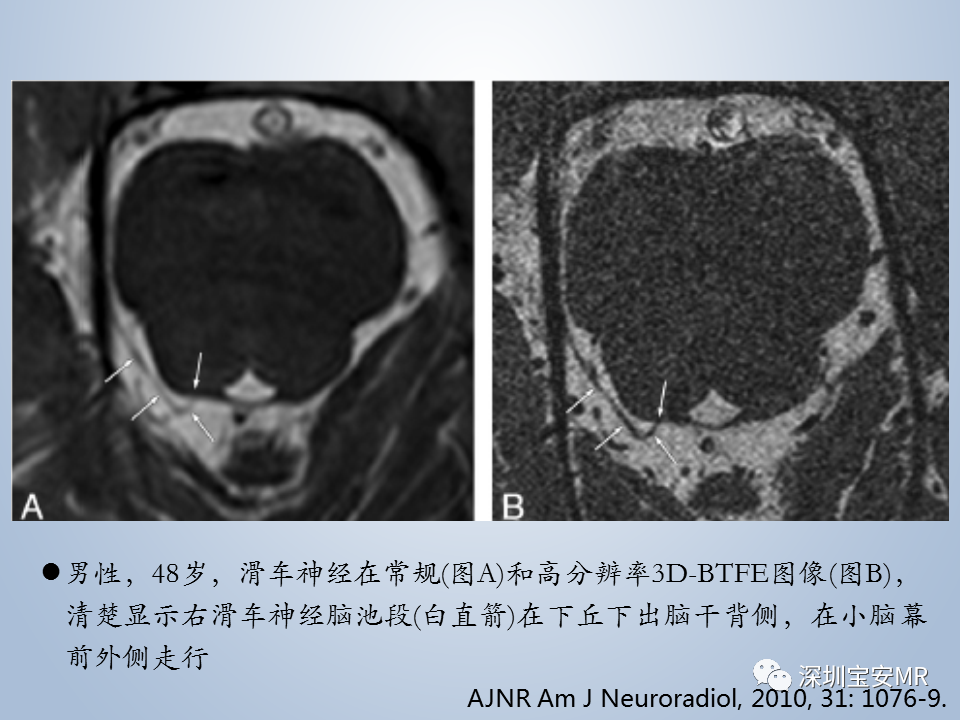 影像PPT - 【PPT】眼球运动障碍影像诊断-13
