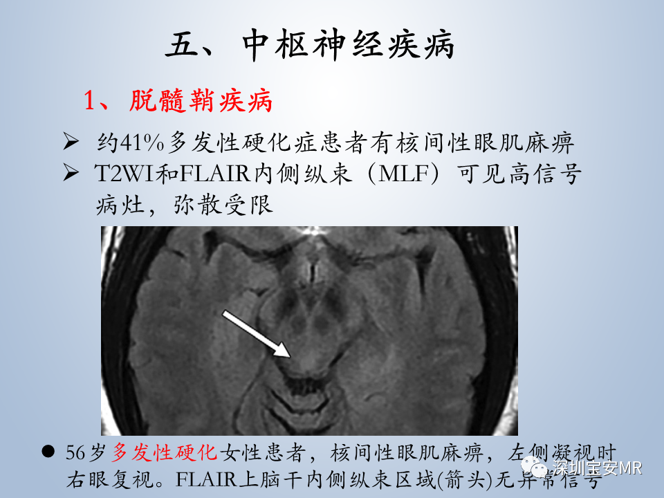 影像PPT - 【PPT】眼球运动障碍影像诊断-22