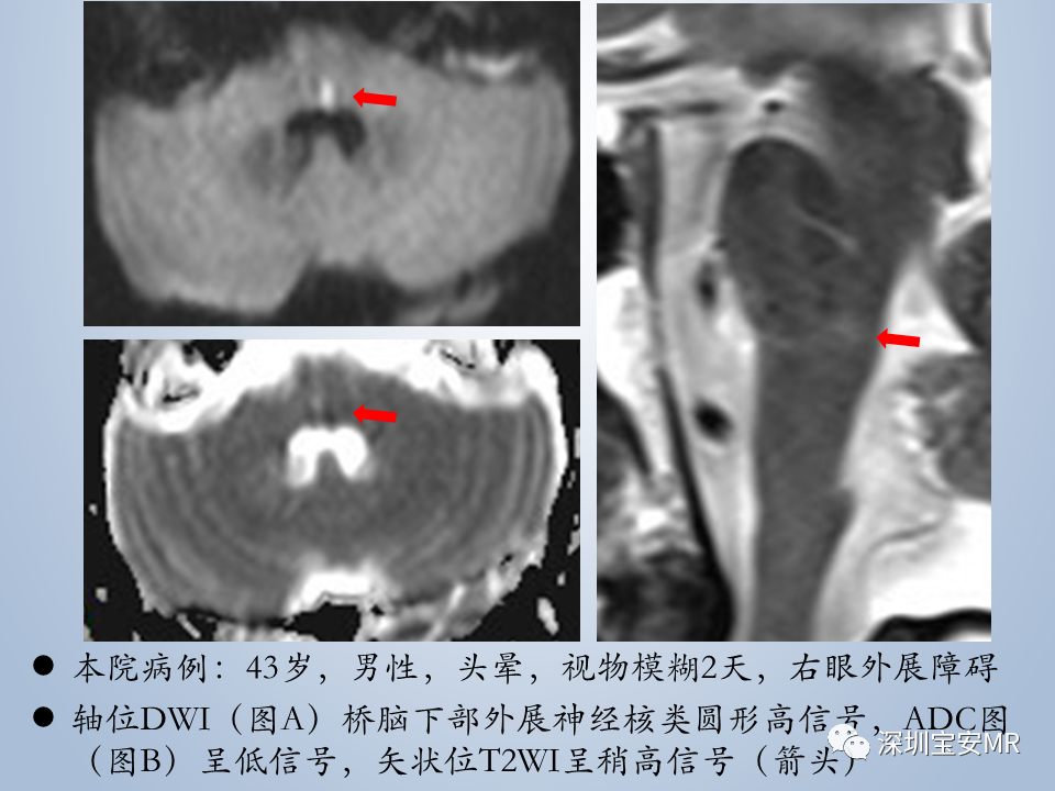 影像PPT - 【PPT】眼球运动障碍影像诊断-24