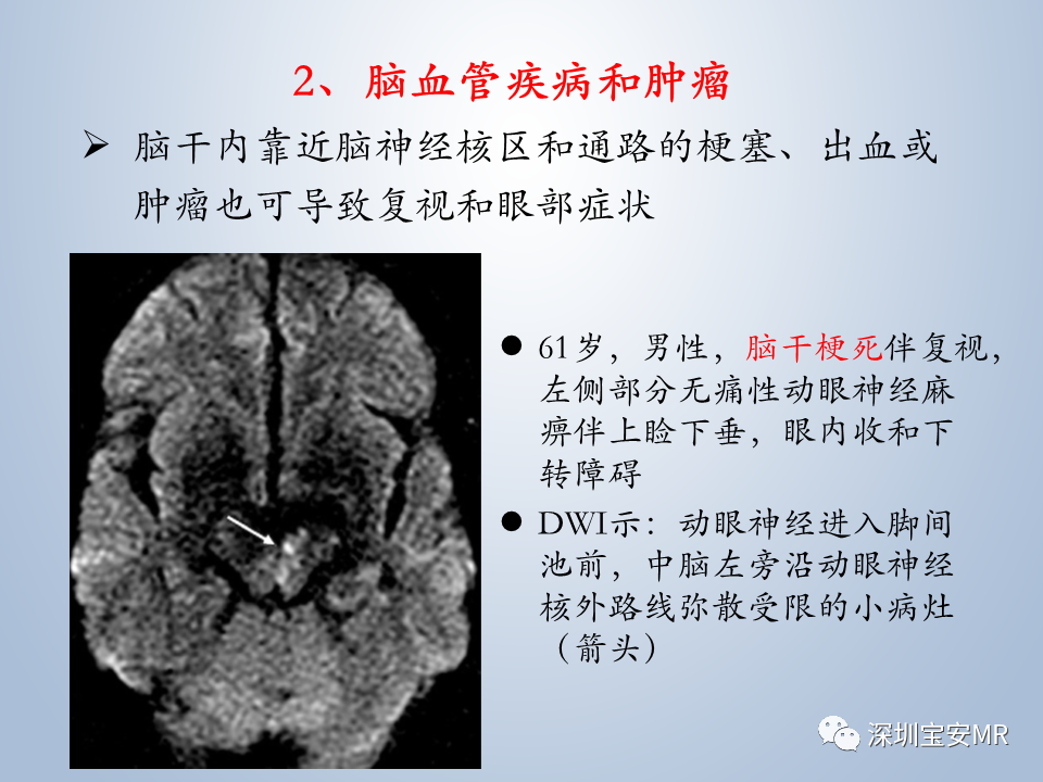 影像PPT - 【PPT】眼球运动障碍影像诊断-23