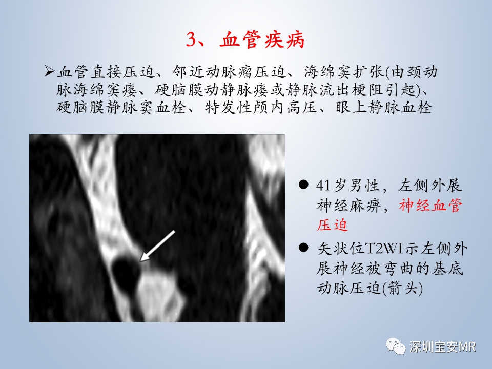 影像PPT - 【PPT】眼球运动障碍影像诊断-30