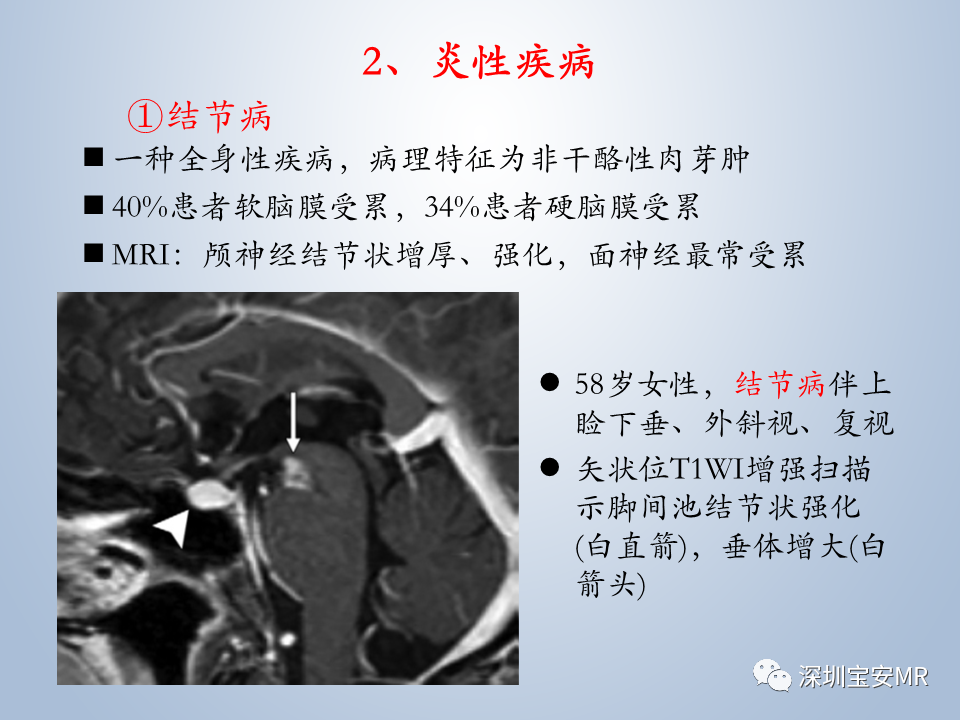 影像PPT - 【PPT】眼球运动障碍影像诊断-28