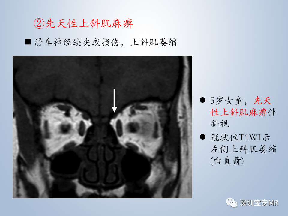 影像PPT - 【PPT】眼球运动障碍影像诊断-27