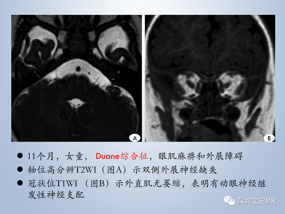 影像PPT - 【PPT】眼球运动障碍影像诊断-26