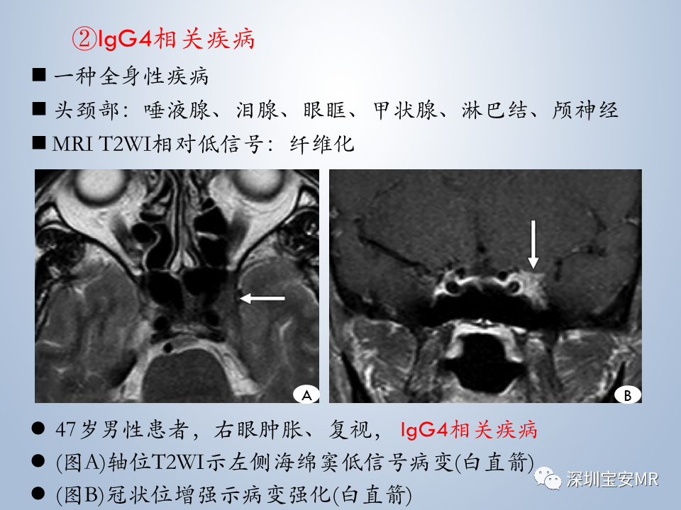 影像PPT - 【PPT】眼球运动障碍影像诊断-29