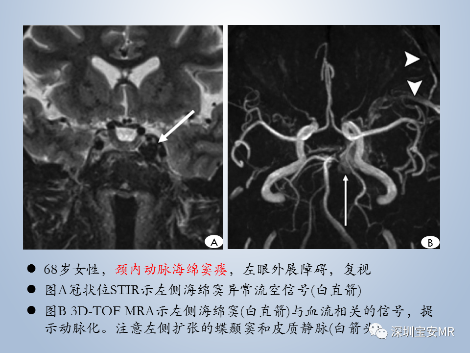 影像PPT - 【PPT】眼球运动障碍影像诊断-31