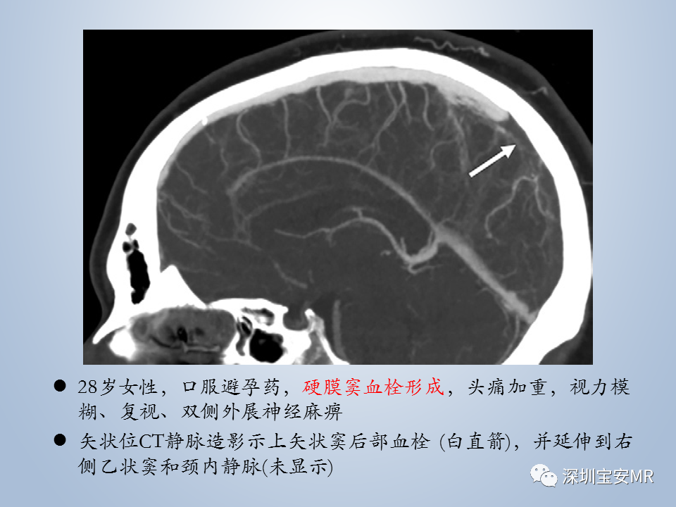影像PPT - 【PPT】眼球运动障碍影像诊断-32