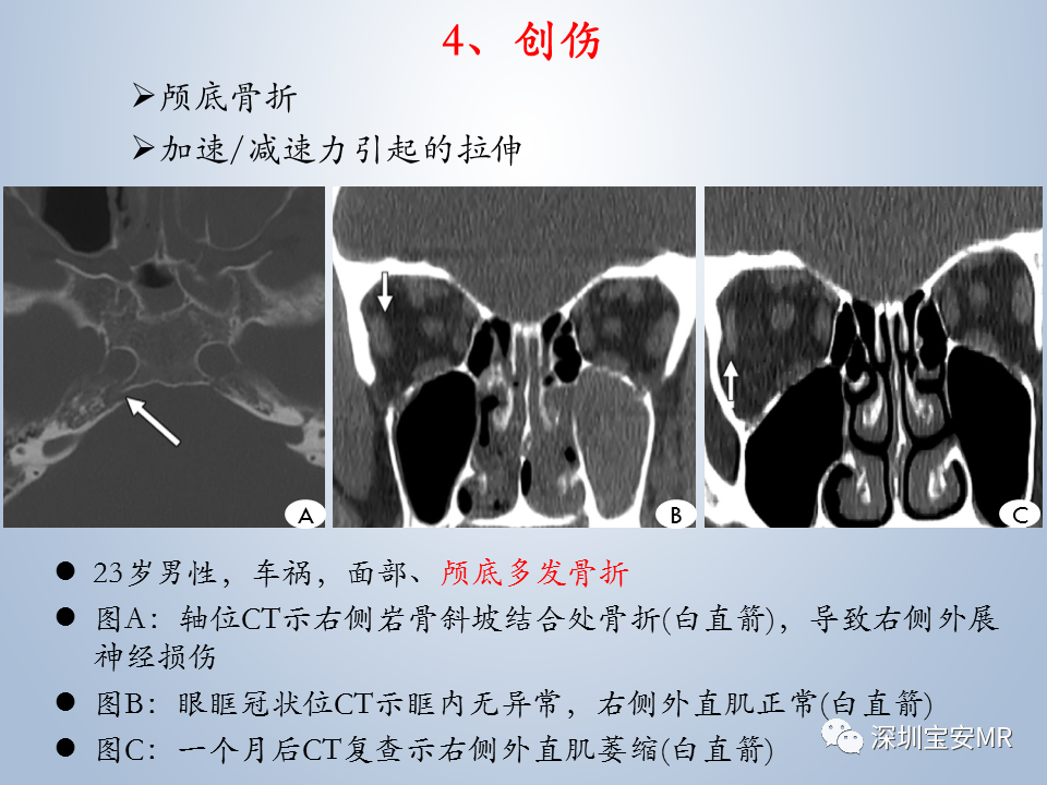 影像PPT - 【PPT】眼球运动障碍影像诊断-34
