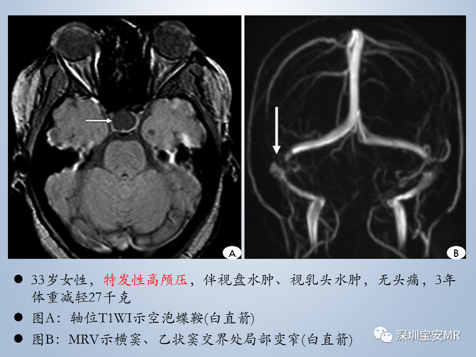 影像PPT - 【PPT】眼球运动障碍影像诊断-33