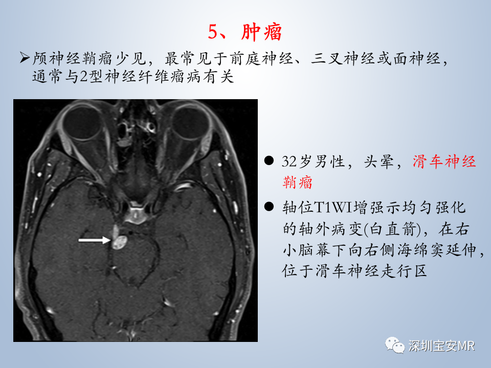 影像PPT - 【PPT】眼球运动障碍影像诊断-35