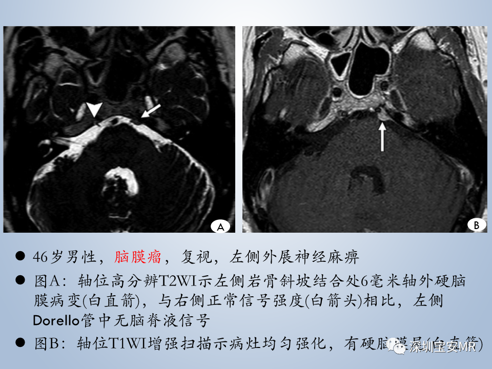影像PPT - 【PPT】眼球运动障碍影像诊断-36