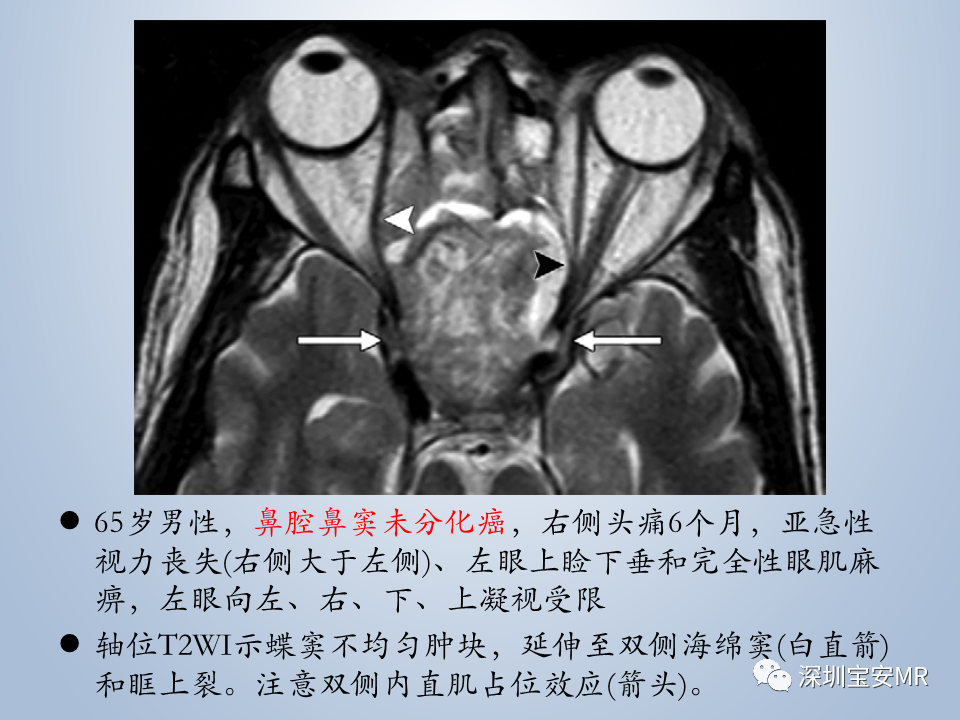 影像PPT - 【PPT】眼球运动障碍影像诊断-37