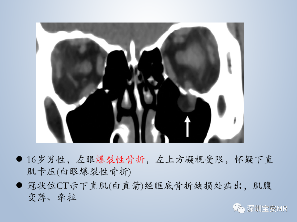 影像PPT - 【PPT】眼球运动障碍影像诊断-40