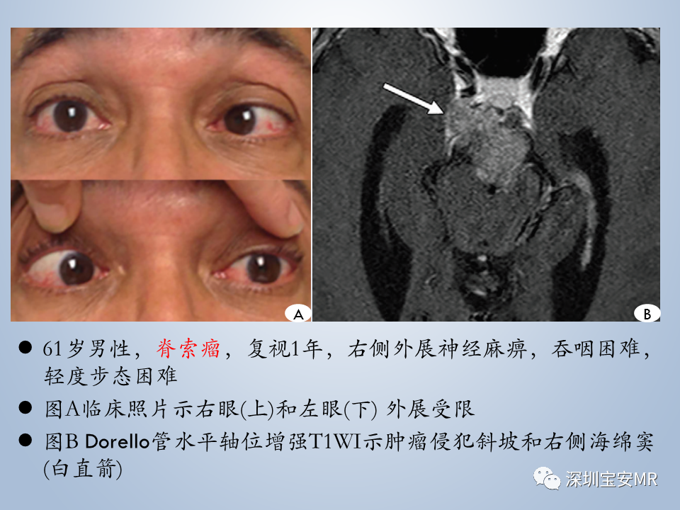 影像PPT - 【PPT】眼球运动障碍影像诊断-38