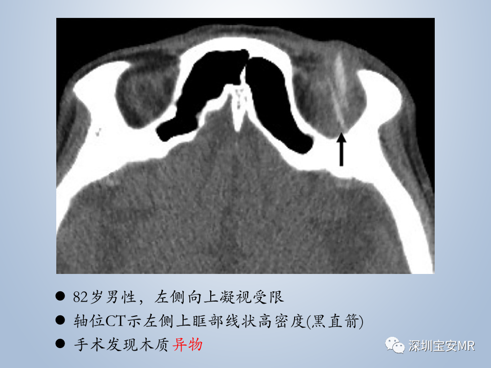 影像PPT - 【PPT】眼球运动障碍影像诊断-41
