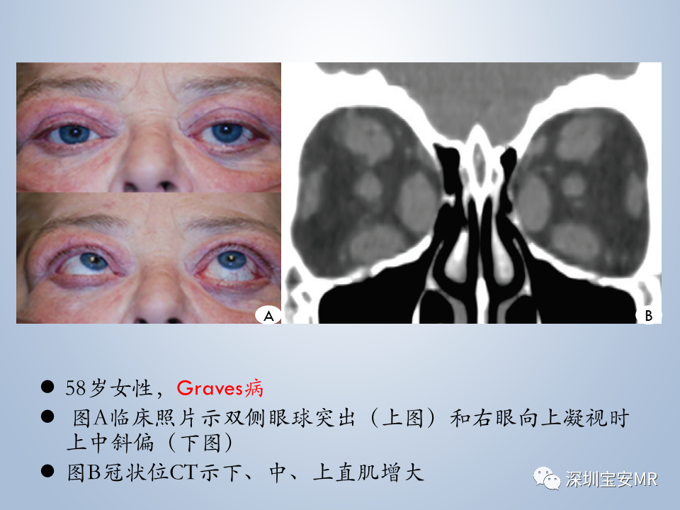 影像PPT - 【PPT】眼球运动障碍影像诊断-43