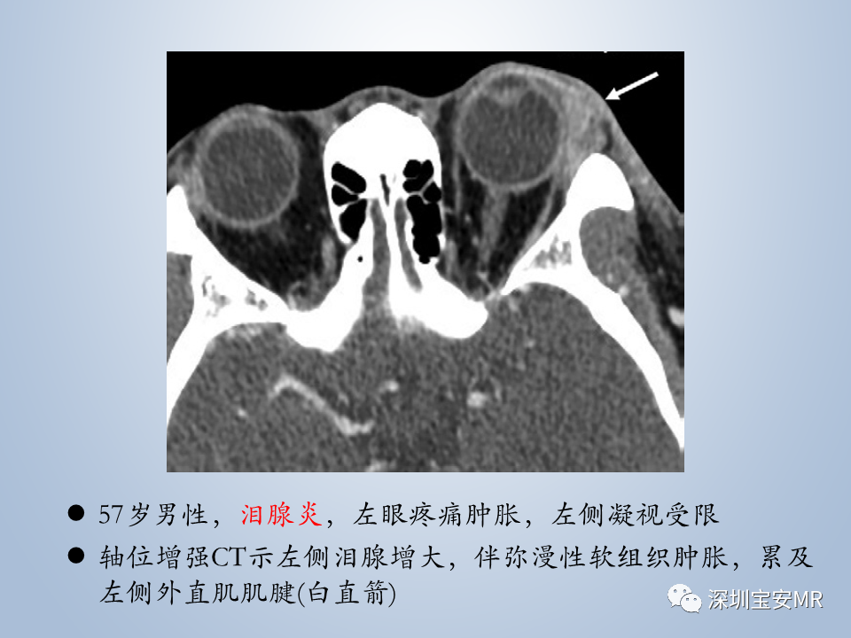 影像PPT - 【PPT】眼球运动障碍影像诊断-47