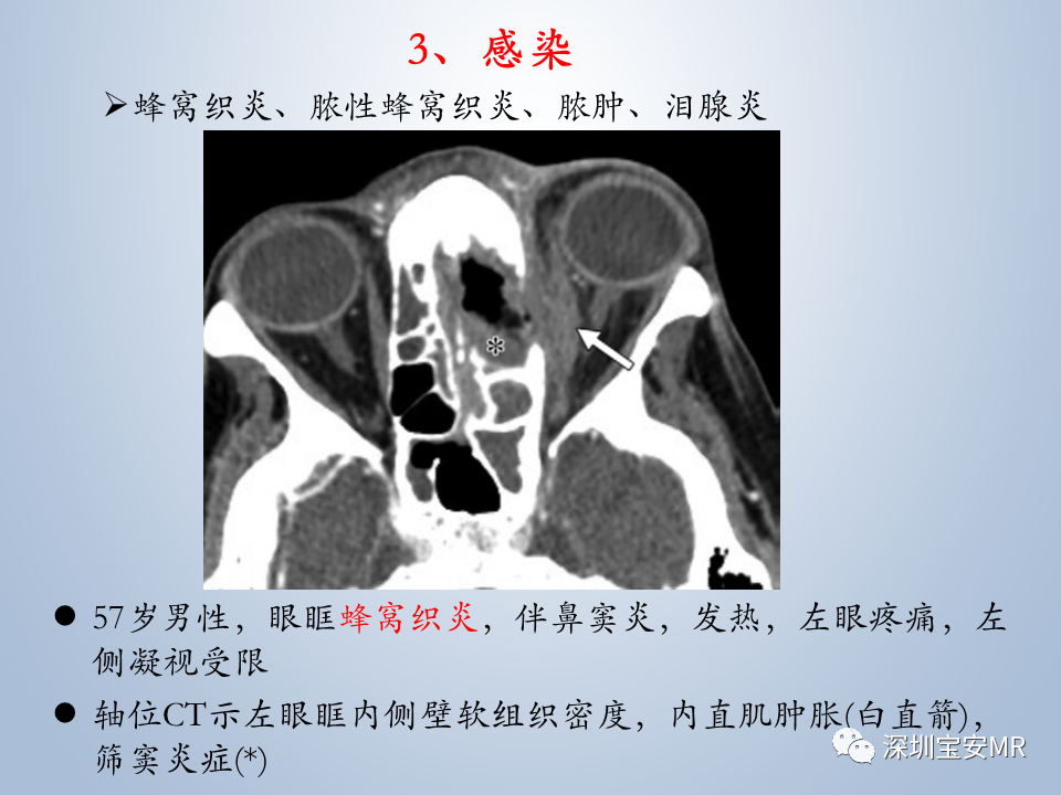 影像PPT - 【PPT】眼球运动障碍影像诊断-46