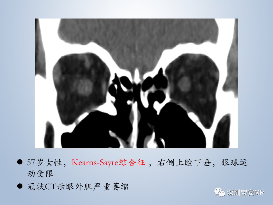 影像PPT - 【PPT】眼球运动障碍影像诊断-45