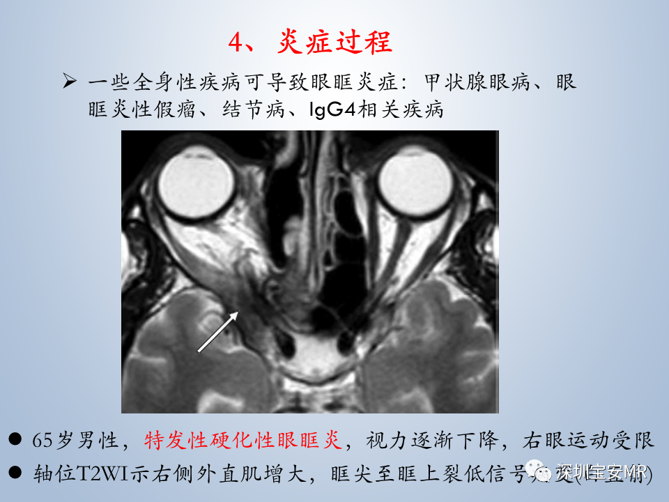 影像PPT - 【PPT】眼球运动障碍影像诊断-48