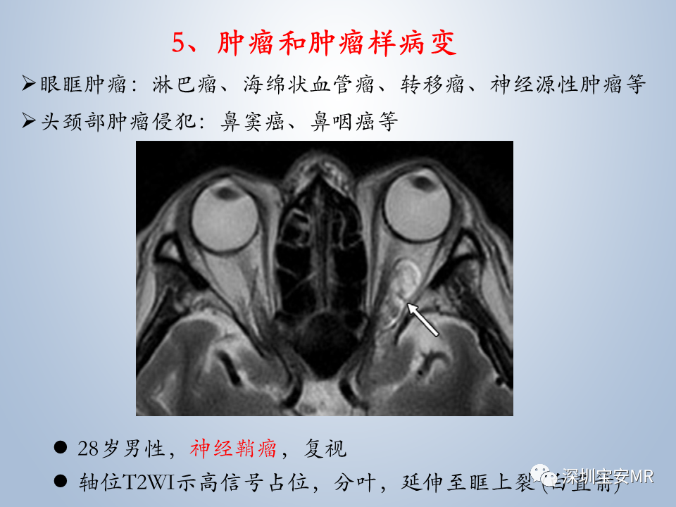影像PPT - 【PPT】眼球运动障碍影像诊断-50