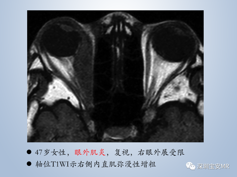 影像PPT - 【PPT】眼球运动障碍影像诊断-49