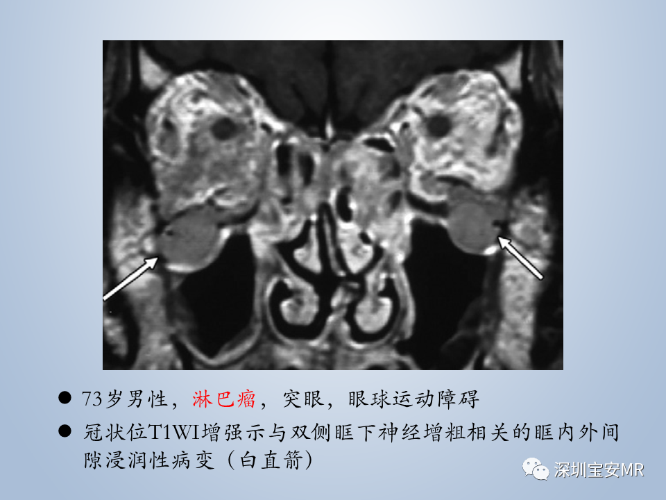 影像PPT - 【PPT】眼球运动障碍影像诊断-51