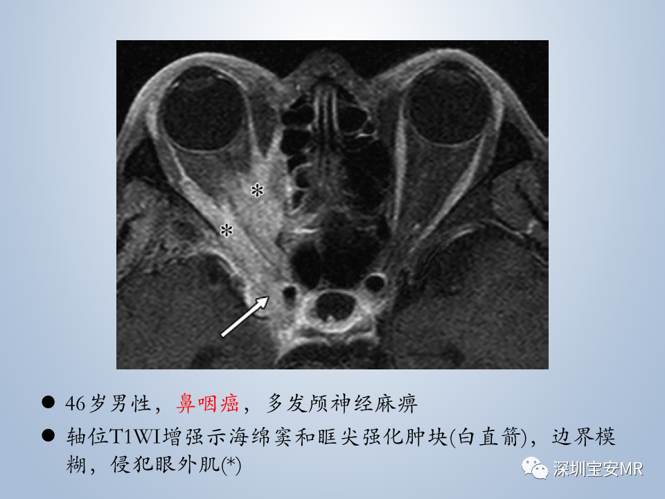 影像PPT - 【PPT】眼球运动障碍影像诊断-52
