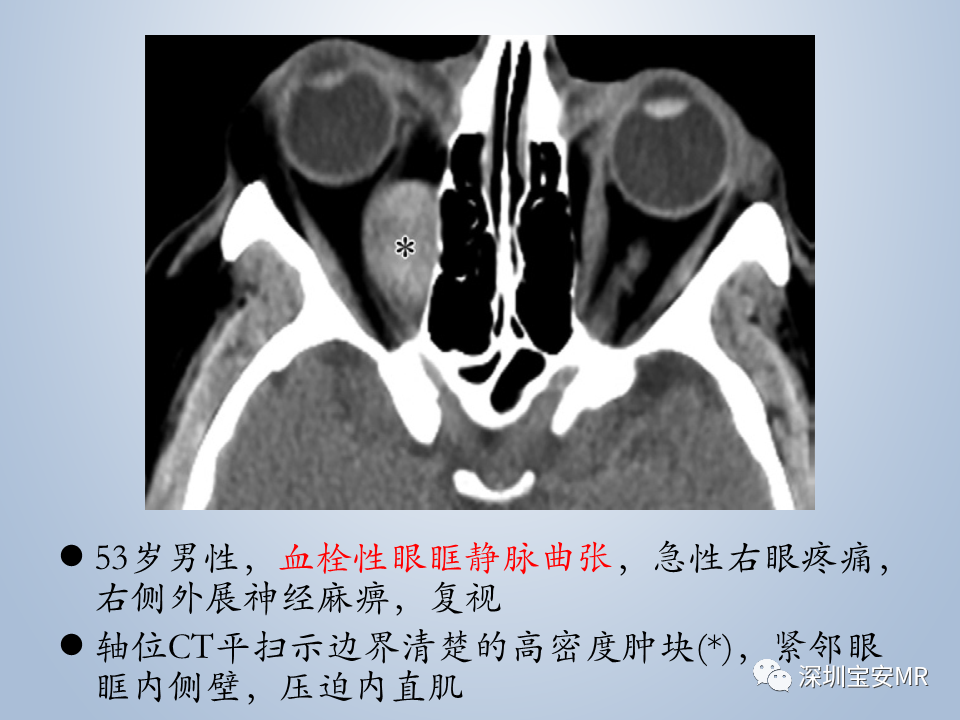 影像PPT - 【PPT】眼球运动障碍影像诊断-53