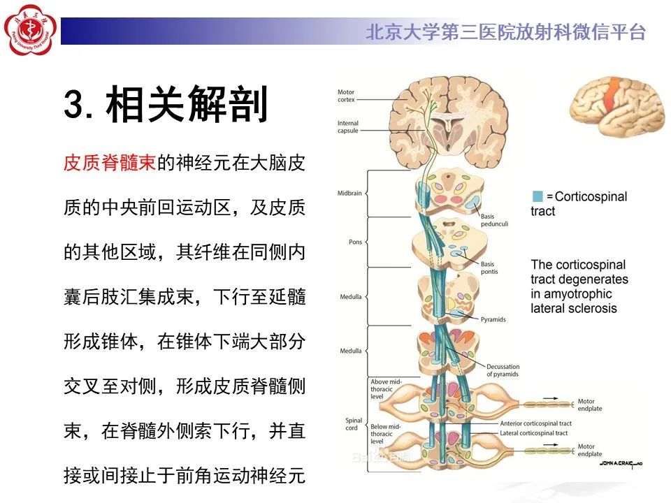 影像PPT - 【PPT】肌萎缩侧索硬化的影像-10