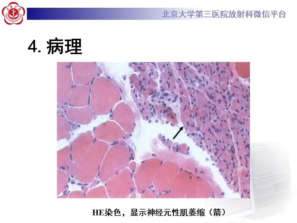 影像PPT - 【PPT】肌萎缩侧索硬化的影像-12