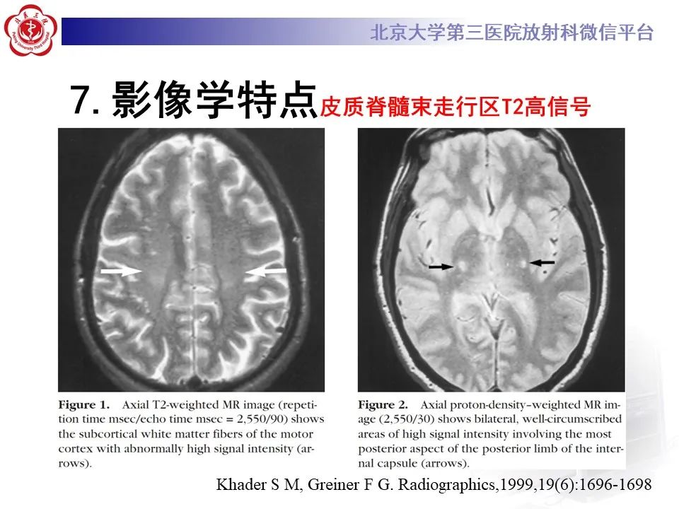 影像PPT - 【PPT】肌萎缩侧索硬化的影像-17