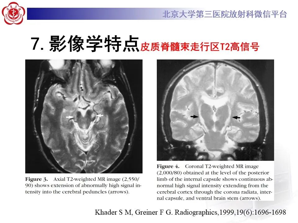 影像PPT - 【PPT】肌萎缩侧索硬化的影像-18