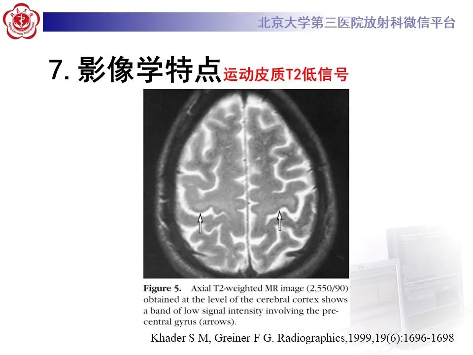 影像PPT - 【PPT】肌萎缩侧索硬化的影像-19