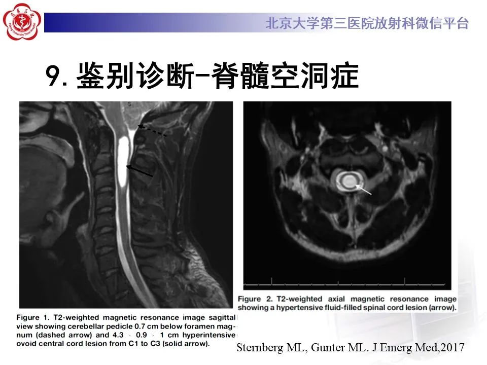 影像PPT - 【PPT】肌萎缩侧索硬化的影像-28