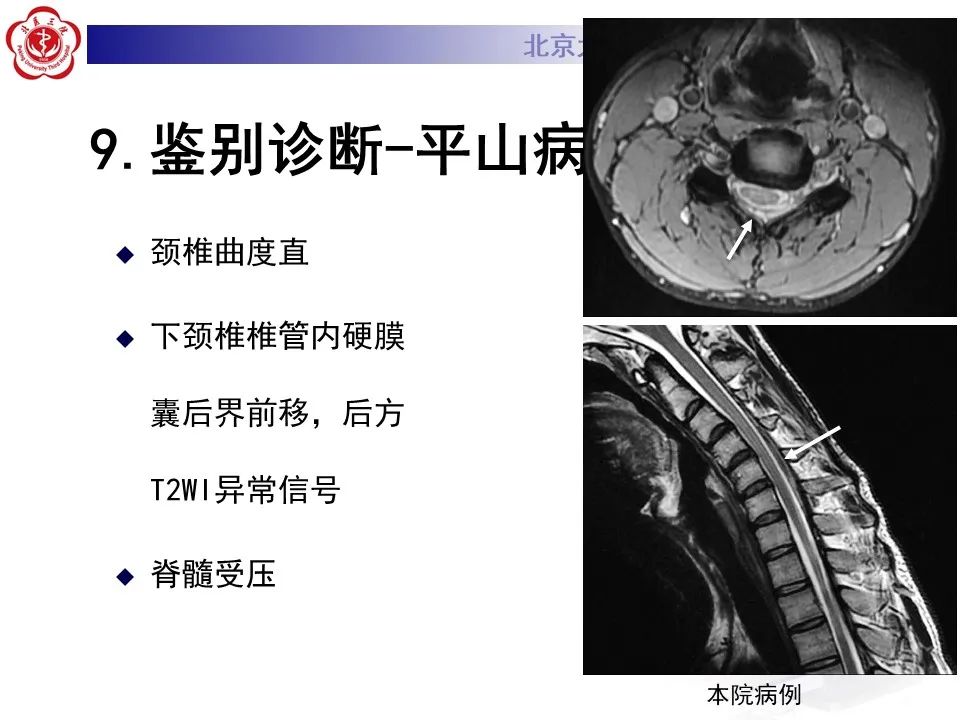 影像PPT - 【PPT】肌萎缩侧索硬化的影像-29