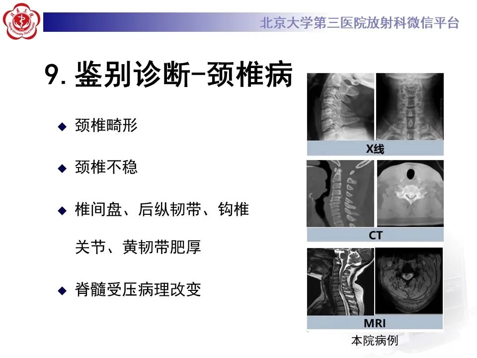 影像PPT - 【PPT】肌萎缩侧索硬化的影像-27