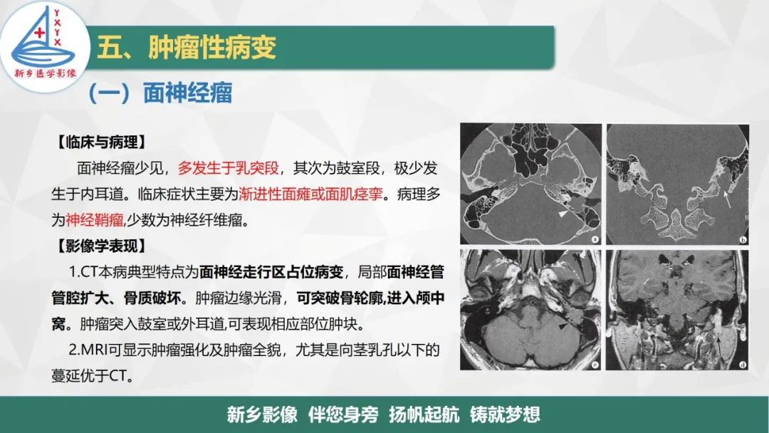 影像PPT - 【PPT】医学影像诊断学教材解读—耳部疾病2-3