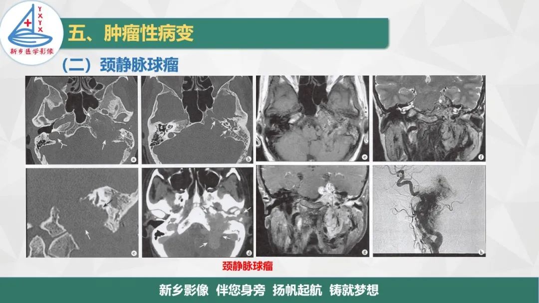 影像PPT - 【PPT】医学影像诊断学教材解读—耳部疾病2-6