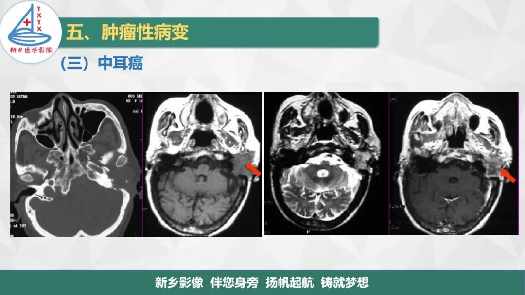影像PPT - 【PPT】医学影像诊断学教材解读—耳部疾病2-9