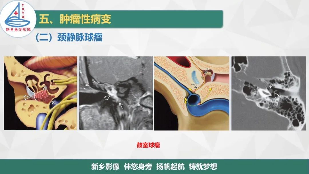 影像PPT - 【PPT】医学影像诊断学教材解读—耳部疾病2-7