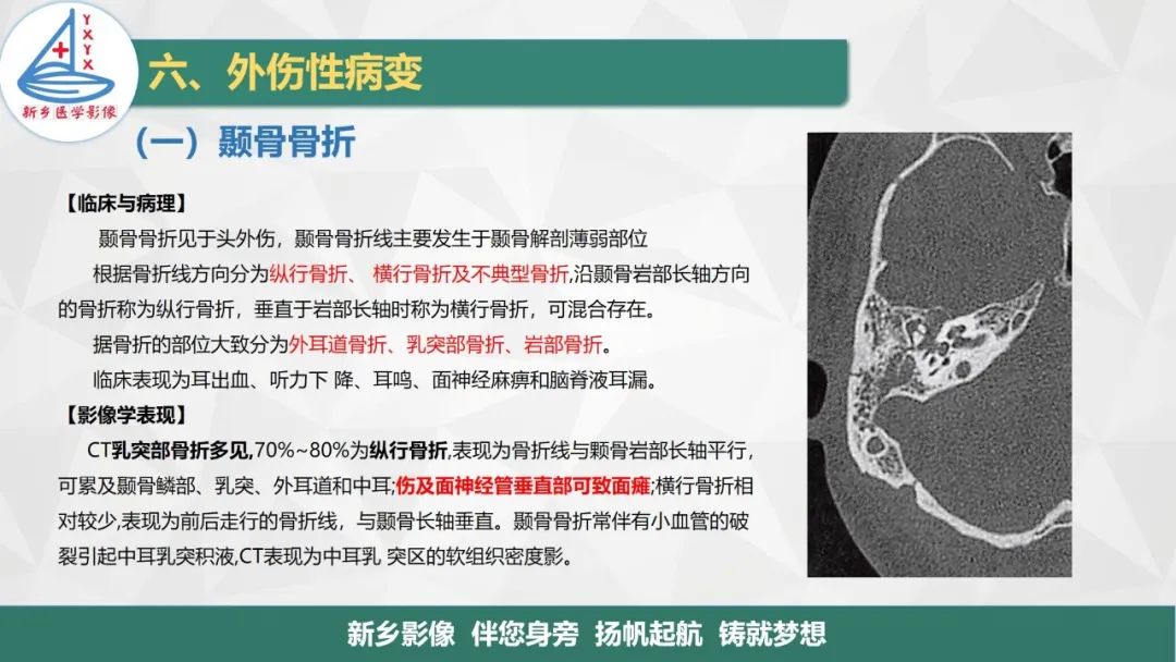 影像PPT - 【PPT】医学影像诊断学教材解读—耳部疾病2-11