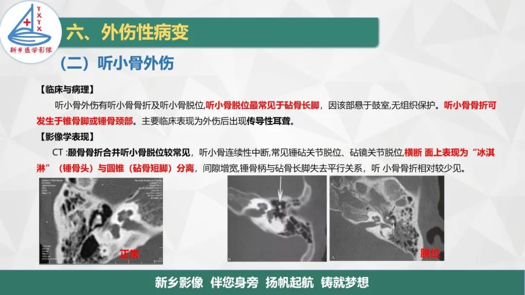 影像PPT - 【PPT】医学影像诊断学教材解读—耳部疾病2-12