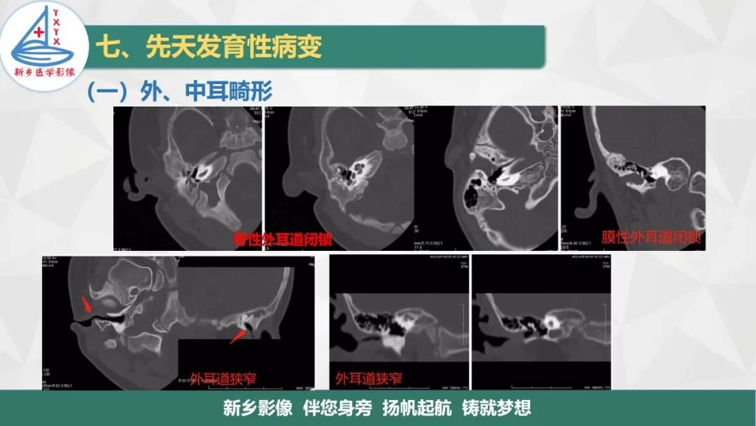 影像PPT - 【PPT】医学影像诊断学教材解读—耳部疾病2-15