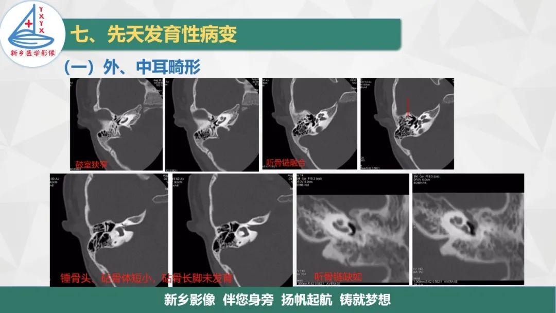 影像PPT - 【PPT】医学影像诊断学教材解读—耳部疾病2-16