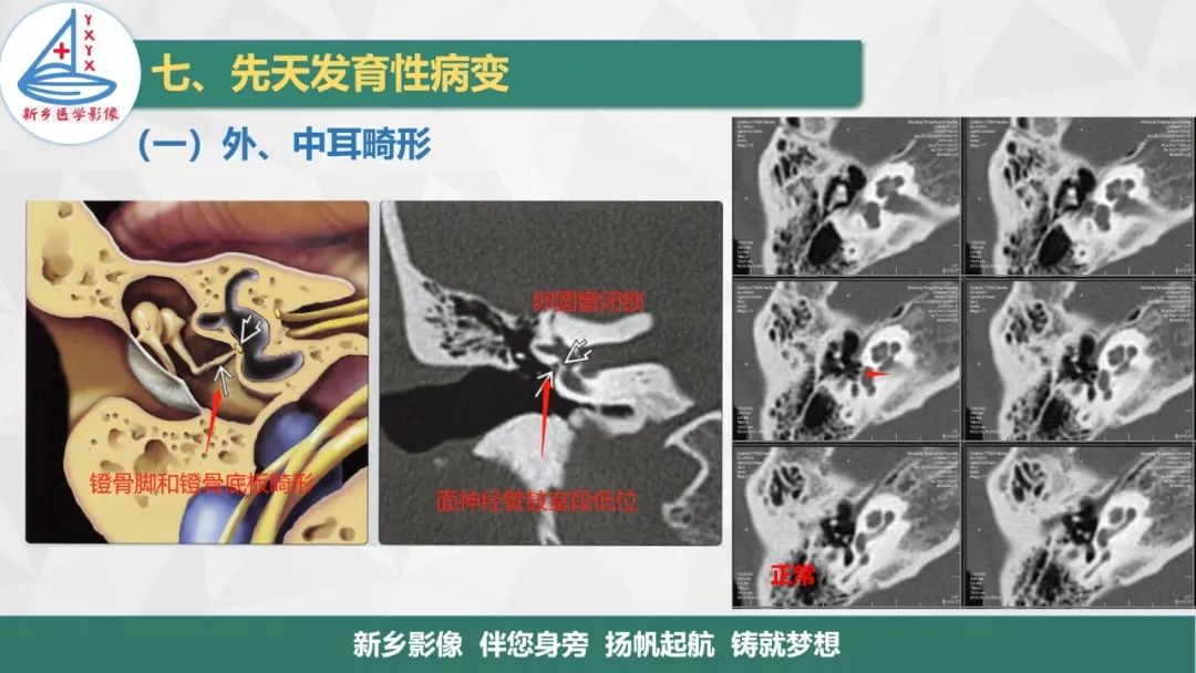影像PPT - 【PPT】医学影像诊断学教材解读—耳部疾病2-17