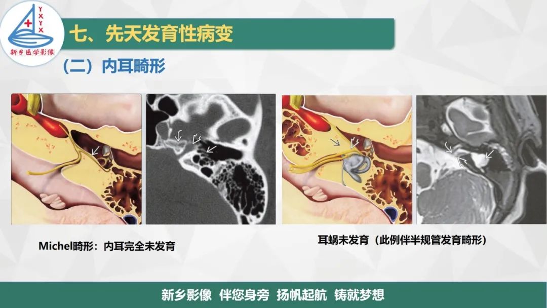 影像PPT - 【PPT】医学影像诊断学教材解读—耳部疾病2-19